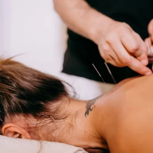 a woman receiving acupuncture