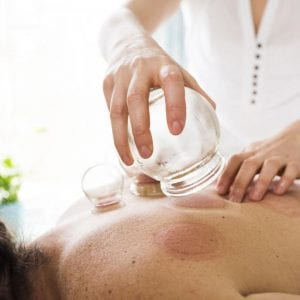 person having cupping therapy
