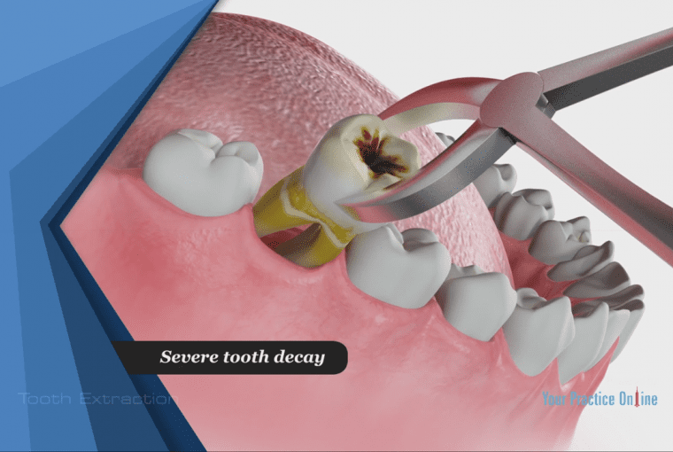 tooth extraction