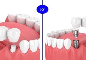 dental implants vs crown