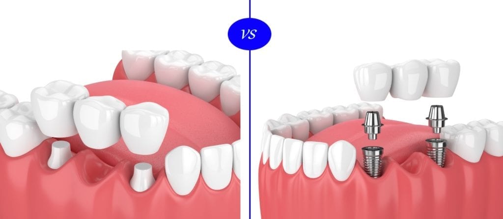 dental implants vs crown