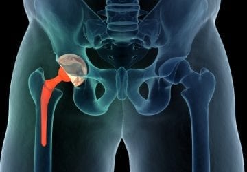 Medically accurate illustration of the hip replacement. 3d illustration.Medically accurate illustration of the hip replacement