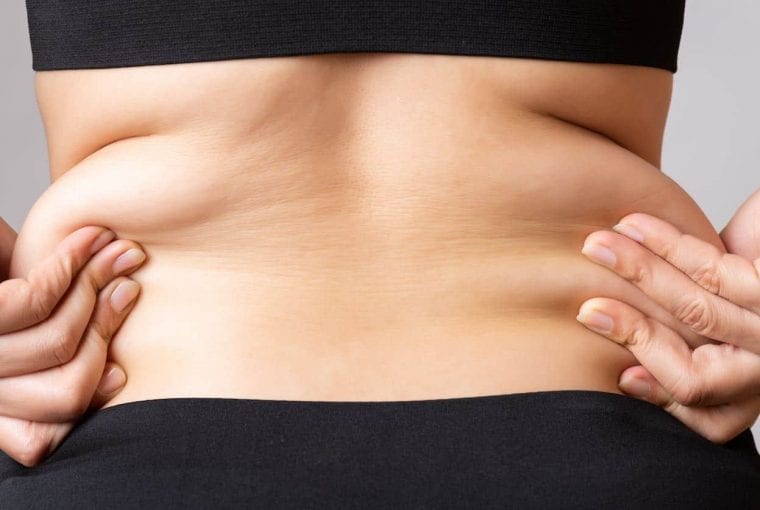 excess skin after weight loss