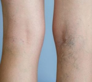 vein care