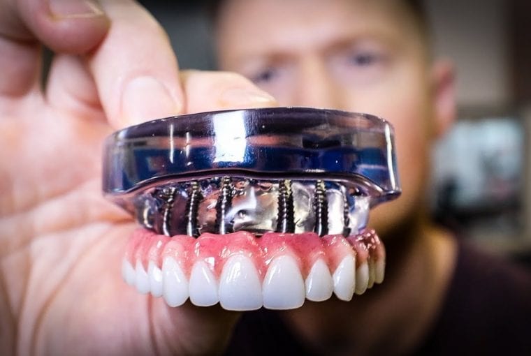 a dentist holding dental implants