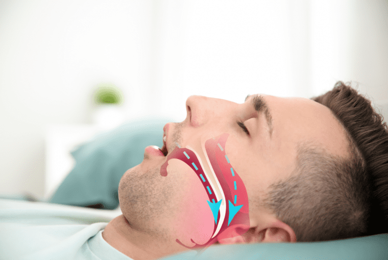 a man with sleep apnea