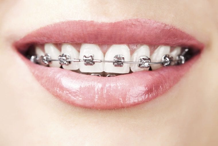 braces