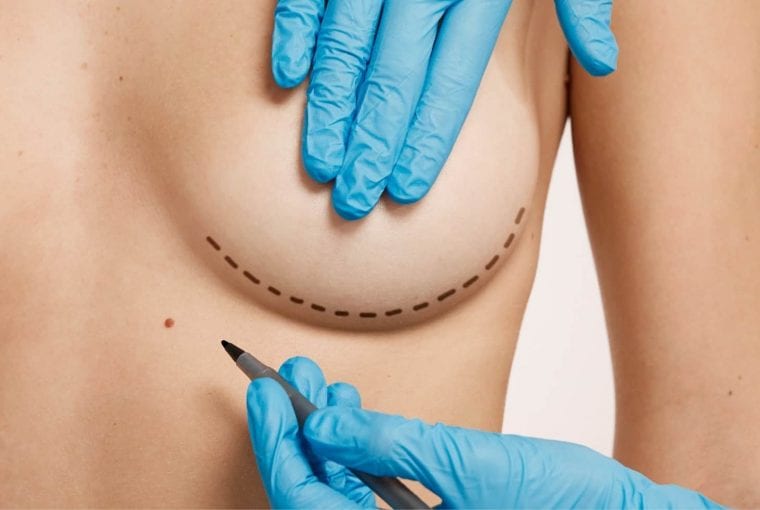 breast augmentation