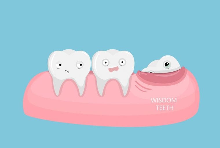 wisdom teeth