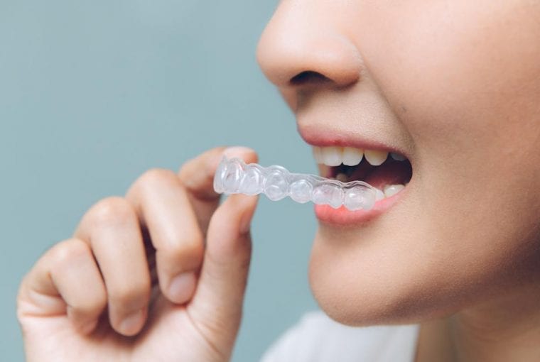 a person inserting invisalign