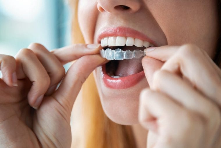 a woman placing invisalign