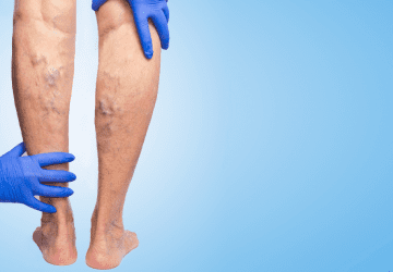 a doctor observing varicose veins