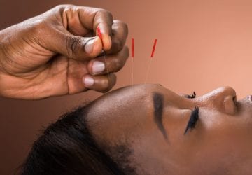 a woman getting acupuncture