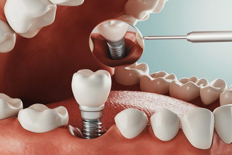 dental implants