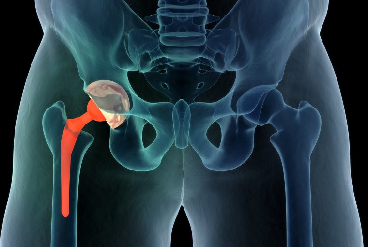 hip replacement
