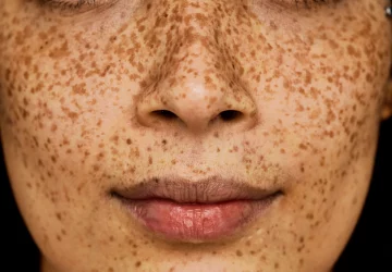 a woman with freckles