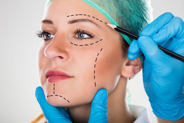 a woman with lines on her face for a facelift surgery