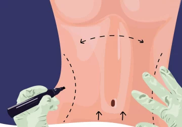 an illustration of someone getting a tummy tuck surgery