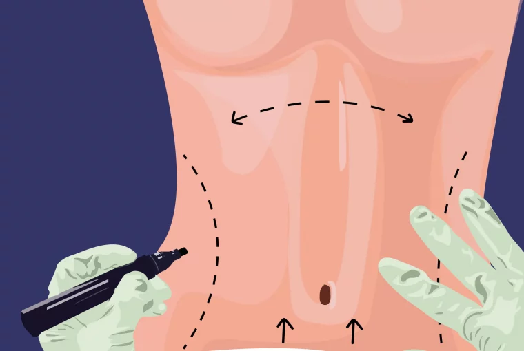 an illustration of someone getting a tummy tuck surgery